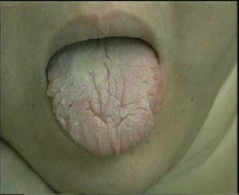 Tungpix裂纹舌.jpg