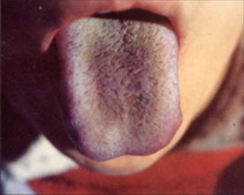 Tungpix紫舌.jpg