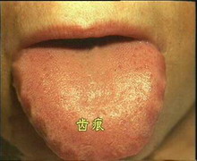 Tungpix齿痕舌.jpg