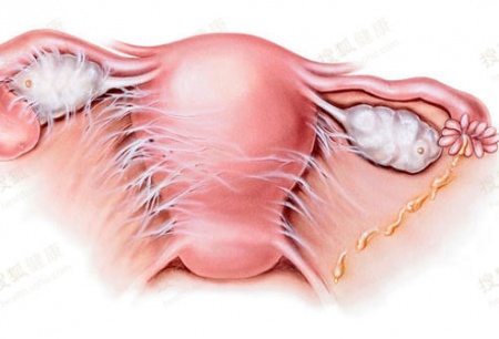 盆腔炎.jpg