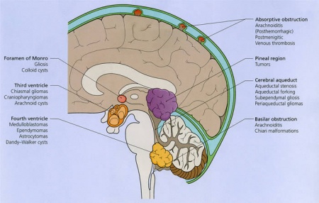 脑水肿.jpg