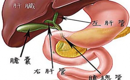 胆管炎.jpg