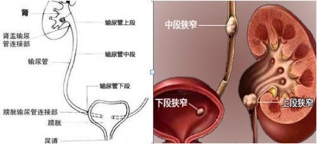 输尿管狭窄.jpg